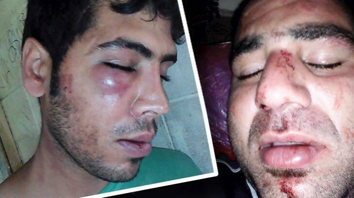 The injuries of two Iranian refugees, Mehdi (left) and Mohammad, allegedly bashed by local authorities on Manus Island. Photo: Supplied