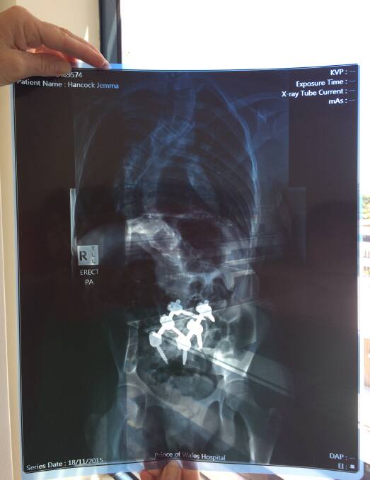 The titanium pins in Jemma's spine.